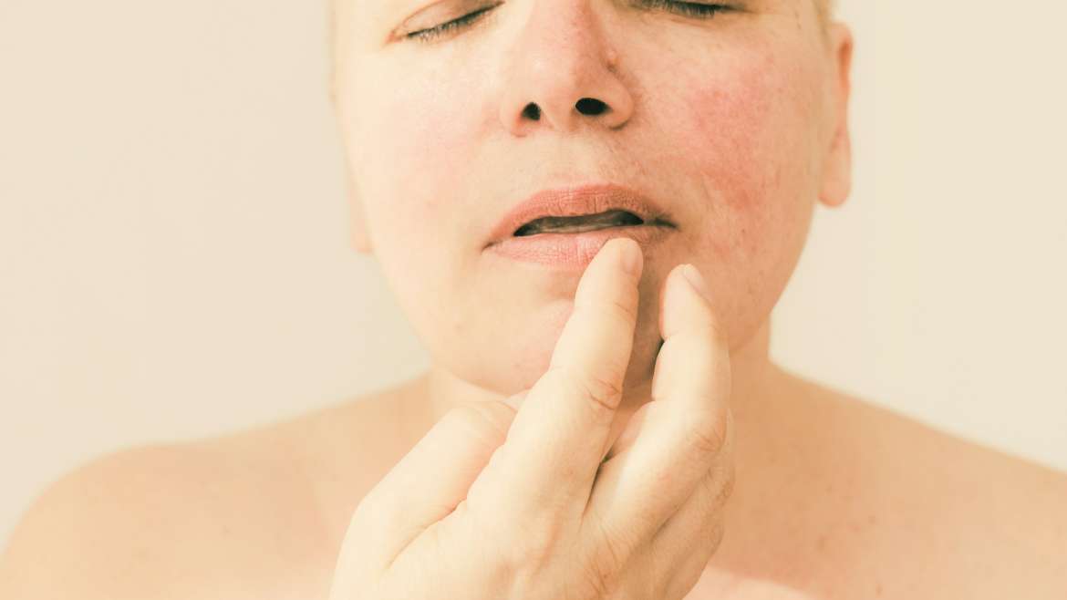 Rosacea